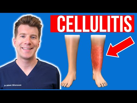 Doctor explains CELLULITIS (skin infection) | Causes, symptoms, treatment (plus photos)